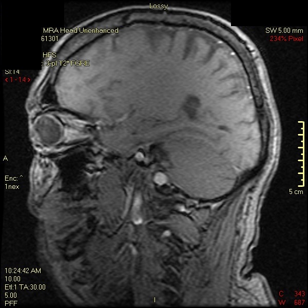 Μαγνητική τομογραφία εγκεφάλου. Στην ημικρανία είναι φυσιολογική, ενώ αν η κλινική διάγνωση είναι σίγουρη, δεν χρειάζεται να γίνει.    